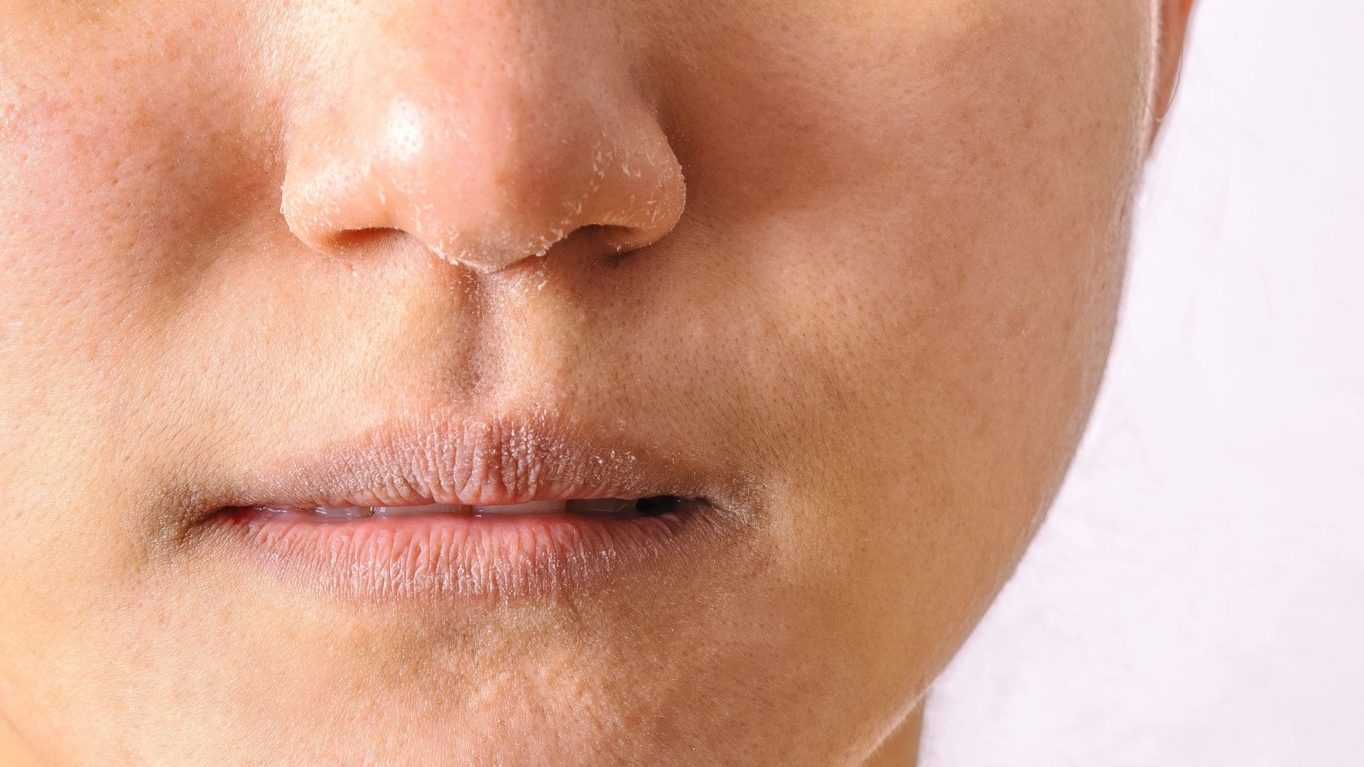 Ako bojovať so suchou pleťou počas zimya